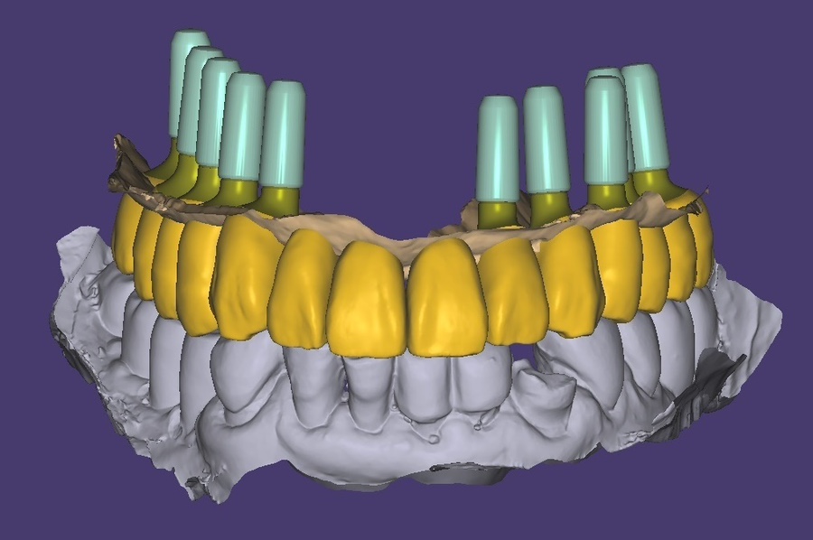 디지털기공 보철물