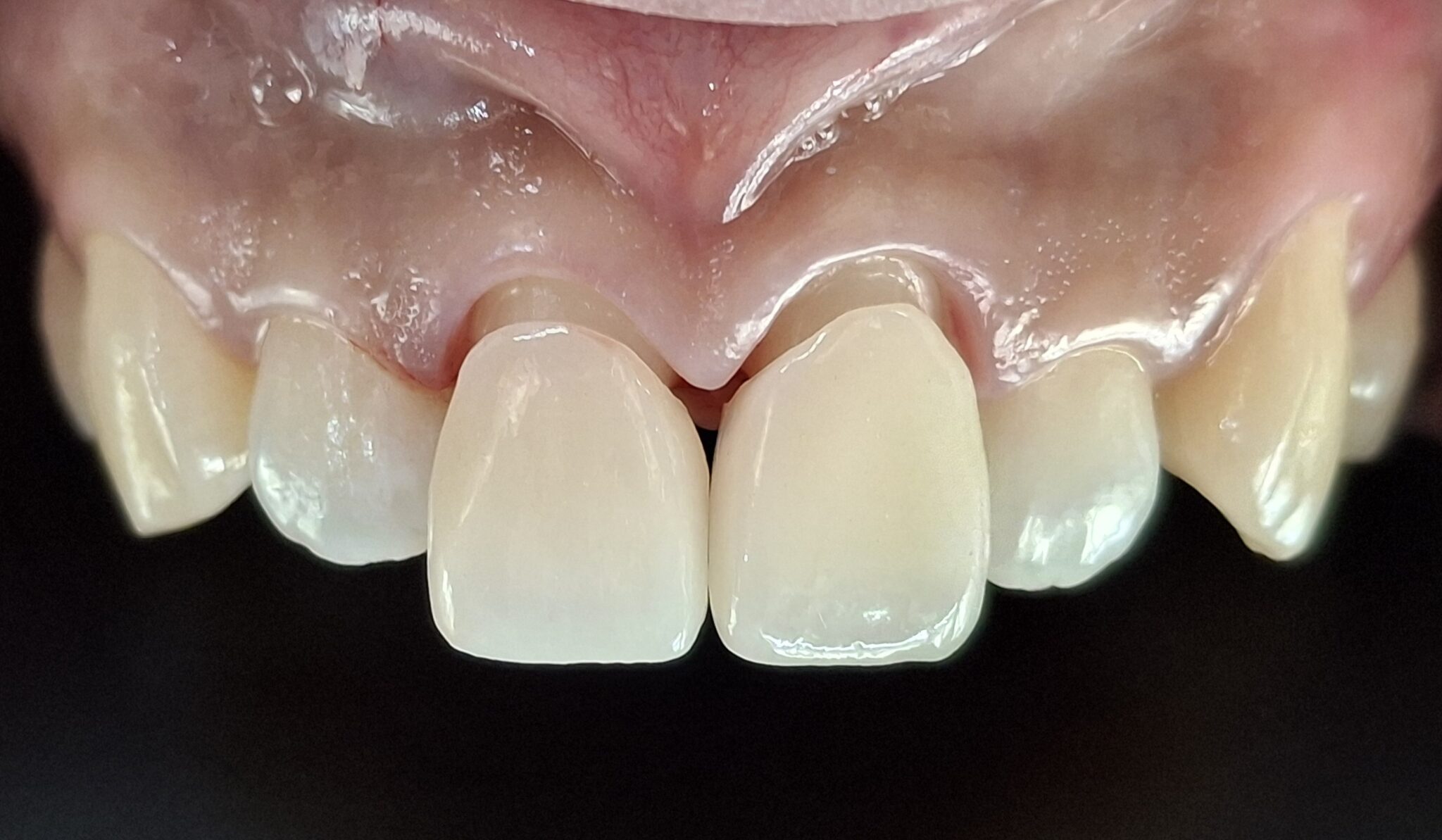 앞니 크라운 브릿지